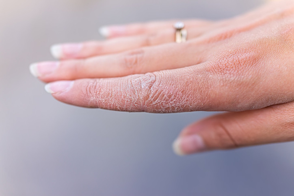 Close-up detailed view of woman's hands showing rough, dry, flaky skin texture with visible moisture barrier damage and uncomfortable tightness requiring intensive moisturizing treatment and gentle skincare routine - InfoProds 2026 beauty health guide