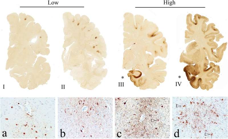 Medical researcher examining brain tissue samples under microscope searching for tau protein deposits and neurofibrillary tangles characteristic of chronic traumatic encephalopathy in former football players, representing groundbreaking neuropathology research revealing 92 percent CTE occurrence rate among studied NFL athletes - InfoProds Medical Science Investigation 2026