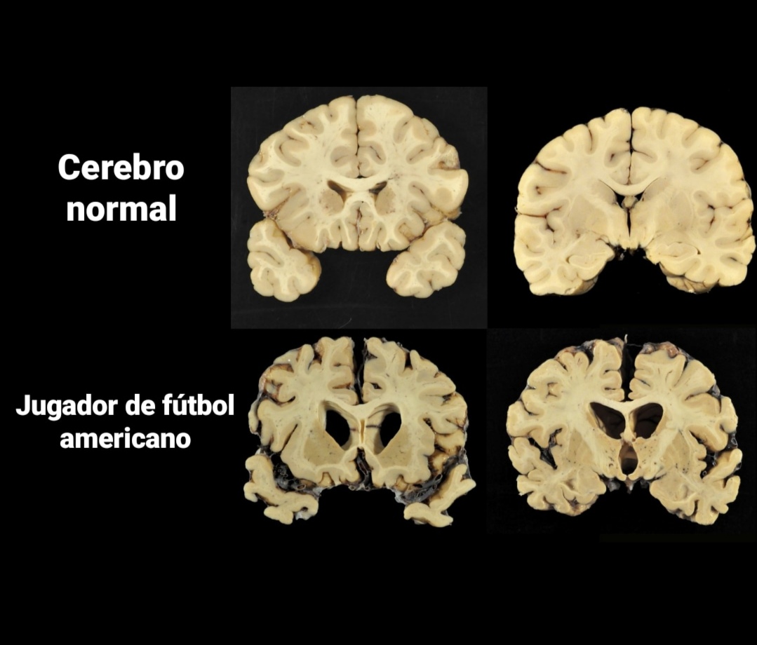 Research laboratory showing brain specimen storage and analysis equipment at Boston University CTE Center where scientists have diagnosed chronic traumatic encephalopathy in 345 of 376 former NFL players studied, revealing shocking prevalence of football-related brain damage through systematic post-mortem tissue examination - InfoProds Neuroscience Research 2026