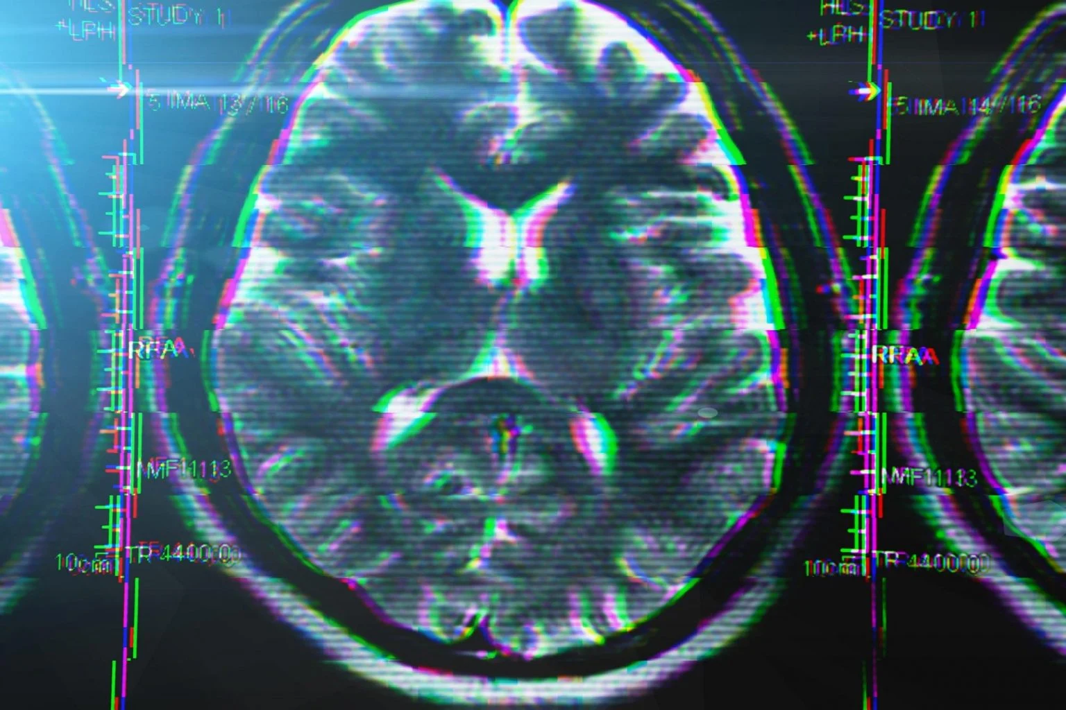 Advanced MRI brain scan revealing white matter hyperintensities and structural abnormalities associated with chronic traumatic encephalopathy in former football player, demonstrating tau protein accumulation patterns and cellular damage caused by years of repetitive sub-concussive hits during professional athletic career - InfoProds Medical Imaging Technology 2026