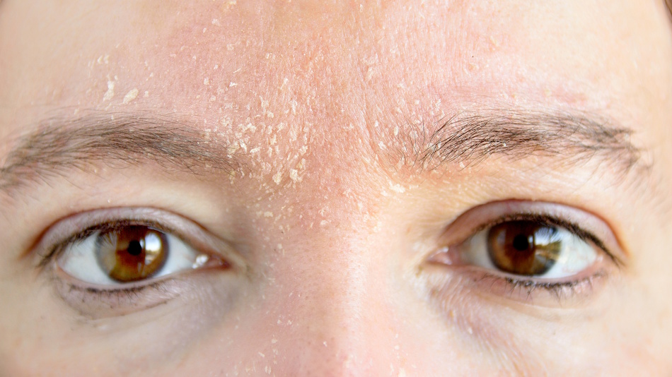 Close-up of winter-damaged dry flaky facial skin showing effects of cold weather and improper skincare products - InfoProds dermatology guide 2026